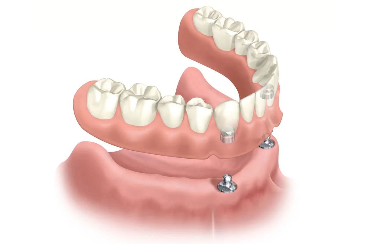 Implant retained denture illustration at Grimsby Denture Clinic